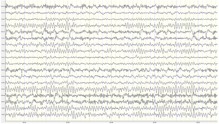 Longitudinal bipolar montage EEG recording at 50 microvolts scale showing posterior rhythm asymmetry